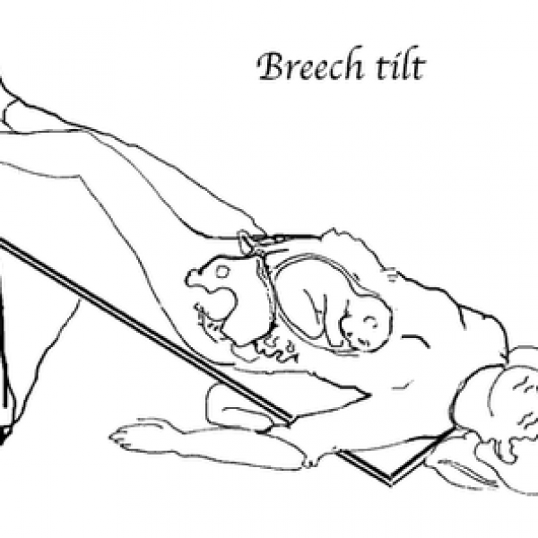 breechtilt position Birthwell Birthright